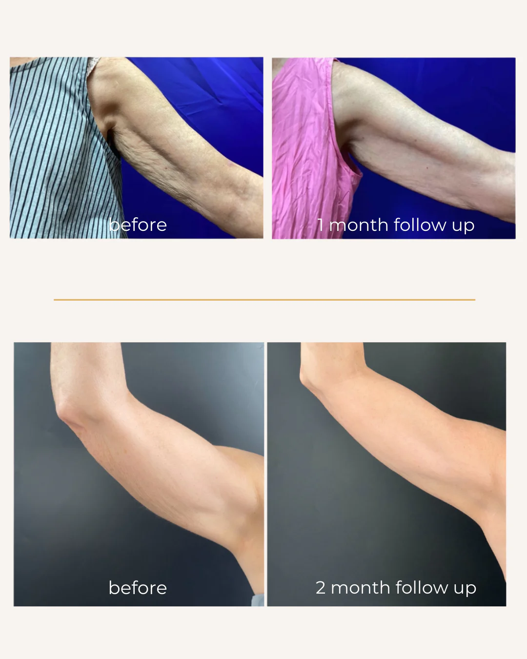 An outstretched upper arm, before Sofwave and one month after
