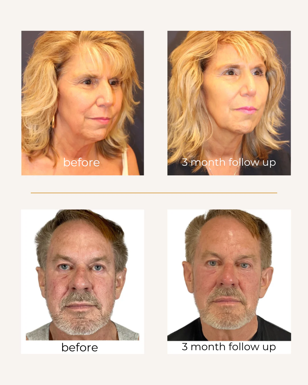 A face in three-quarter view, before Sofwave and three months after