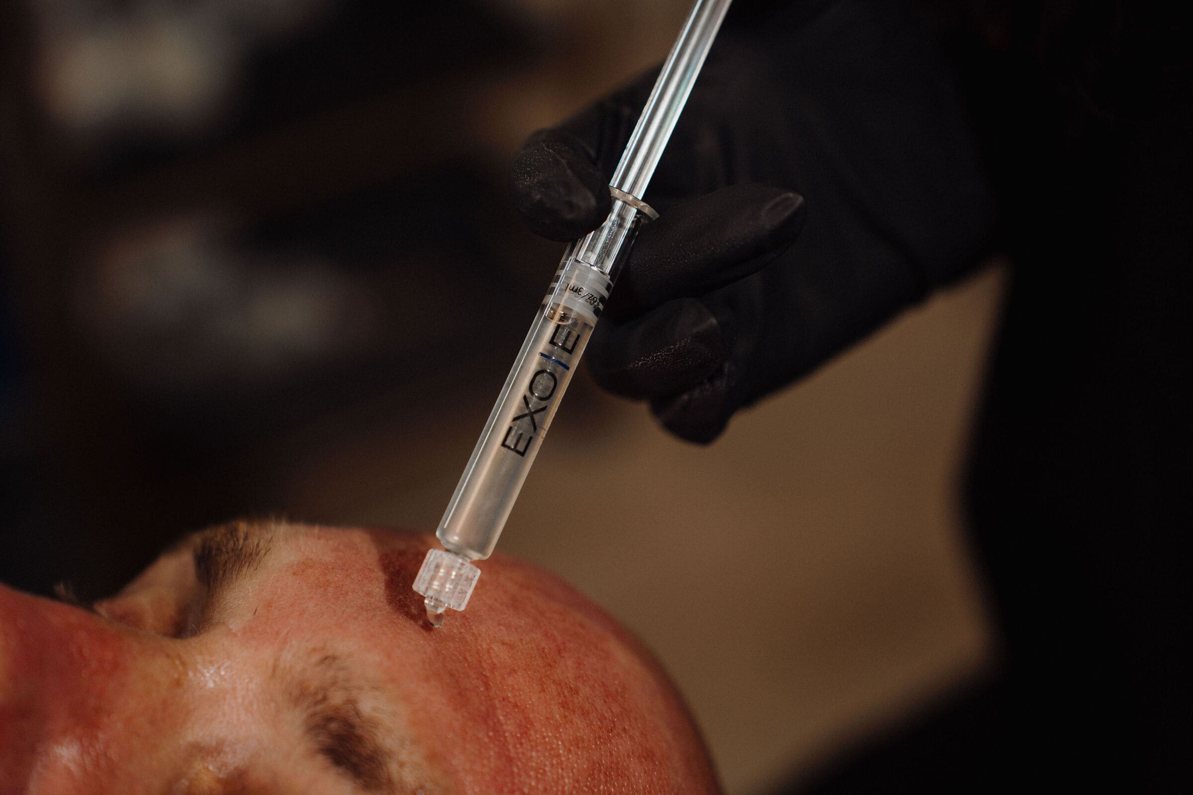 EXO|E being applied to freshly treated skin